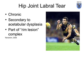 Hip Joint Labral Tear
• Chronic
• Secondary to
acetabular dysplasia
• Part of “rim lesion”
complex
Renström, 2008
MOB TCD
 