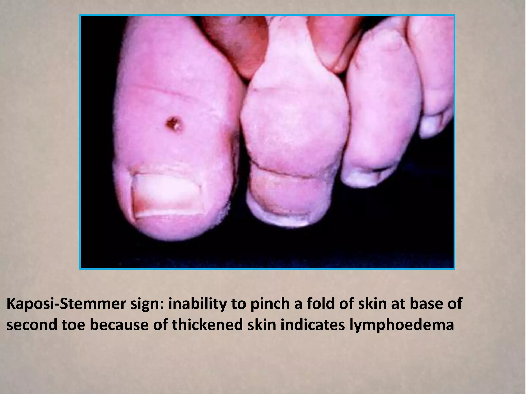 Kaposi-Stemmer sign: inability to pinch a fold of skin at base of
second toe because of thickened skin indicates lymphoedema
 