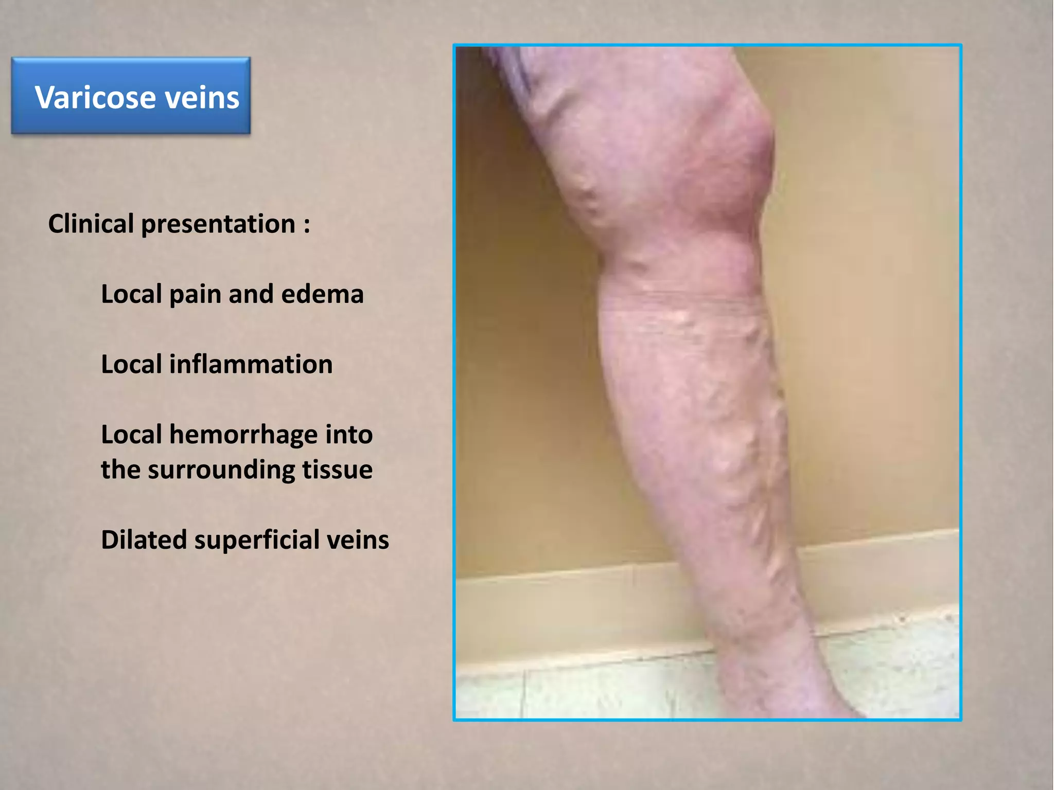 Varicose veins


Clinical presentation :

    Local pain and edema

    Local inflammation

    Local hemorrhage into
    the surrounding tissue

    Dilated superficial veins
 