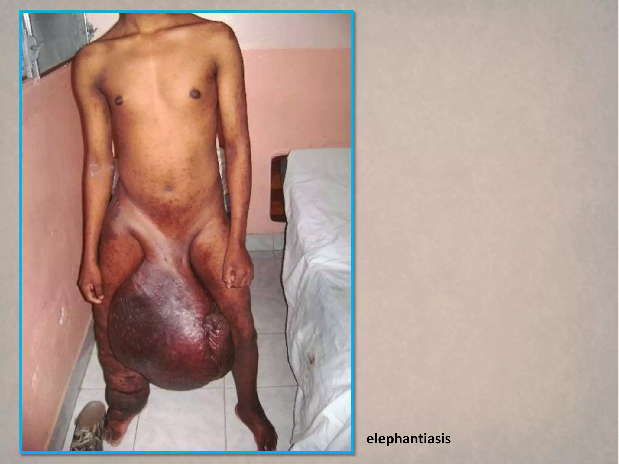 elephantiasis
 