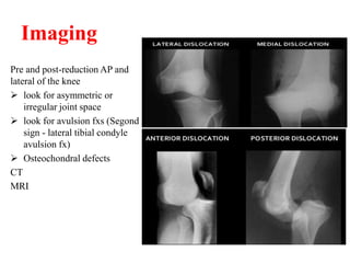 Imaging
Pre and post-reduction AP and
lateral of the knee
 look for asymmetric or
irregular joint space
 look for avulsion fxs (Segond
sign - lateral tibial condyle
avulsion fx)
 Osteochondral defects
CT
MRI
 