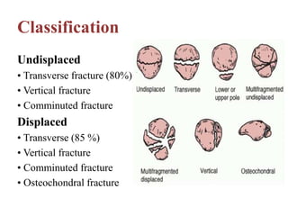 Classification
Undisplaced
• Transverse fracture (80%)
• Vertical fracture
• Comminuted fracture
Displaced
• Transverse (85 %)
• Vertical fracture
• Comminuted fracture
• Osteochondral fracture
 
