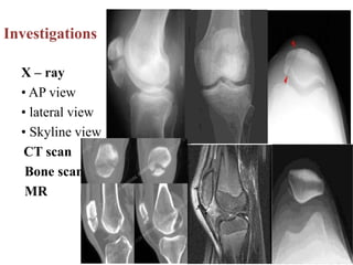 Investigations
X – ray
• AP view
• lateral view
• Skyline view
CT scan
Bone scan
MR
 