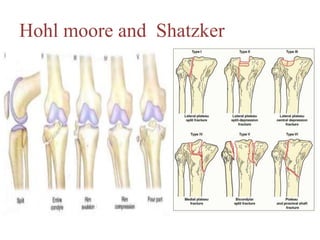 Hohl moore and Shatzker
 