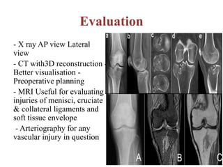Evaluation
- X ray AP view Lateral
view
- CT with3D reconstruction -
Better visualisation -
Preoperative planning
- MRI Useful for evaluating
injuries of menisci, cruciate
& collateral ligaments and
soft tissue envelope
- Arteriography for any
vascular injury in question
 