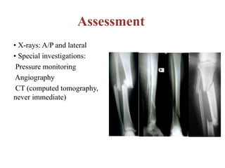 Assessment
• X-rays: A/P and lateral
• Special investigations:
Pressure monitoring
Angiography
CT (computed tomography,
never immediate)
 