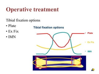 Operative treatment
Tibial fixation options
• Plate
• Ex Fix
• IMN
 