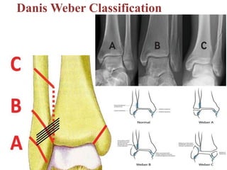Danis Weber Classification
 