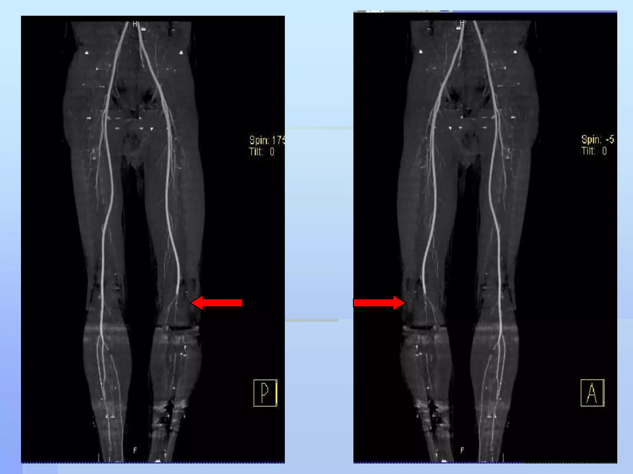 The Pt referred to Ortho team initiallyBack slab applied to stabilize the Fr.The vascular team was called Prompt initial assessment revealed Absent pedal pulses on Rt lower limbPreserved sensations despite other signs of acute ischemia PulselessPalorParasthesiaPain 
