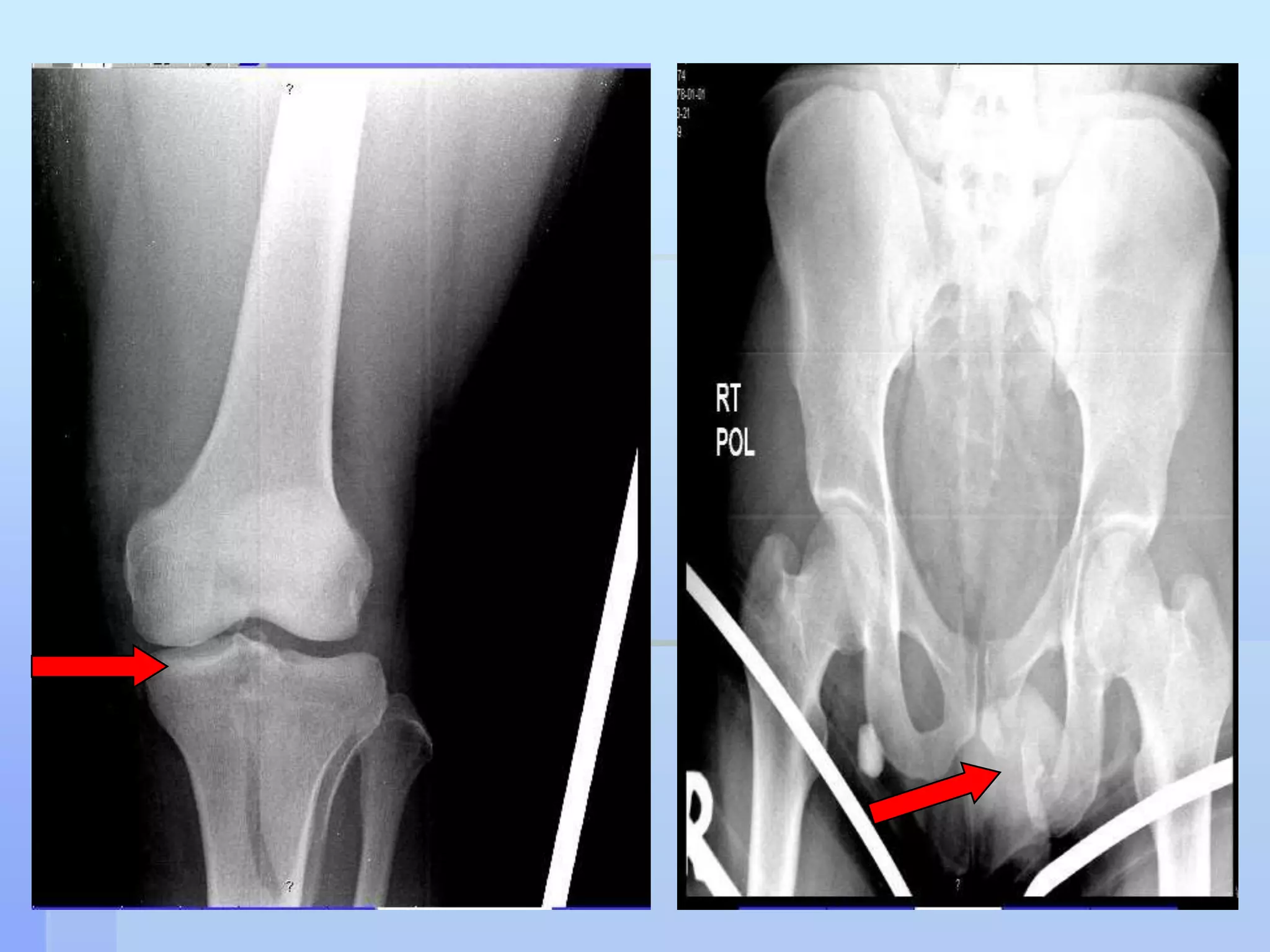 Progress Pt did well The vascularity remained intactHe developed foot drop (torn muscles)Not ischemic neuropathySkin grafting was done He was discharged with the Ex FixHe regained intact P.tibial pulse & well perfused foot