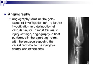 Angiography<br />Angiography remains the gold-standard investigation for the further investigation and delineation of vasc...