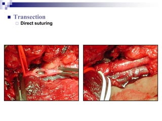 Transection<br />Direct suturing<br />