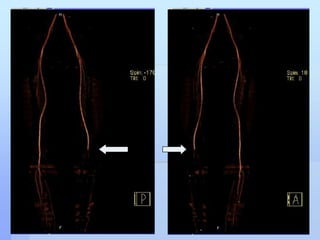 Prompt Doppler assessment revealed no detectable flow over D.pedis & P.tibial<br />CT angiogram showed <br />Normal flow t...