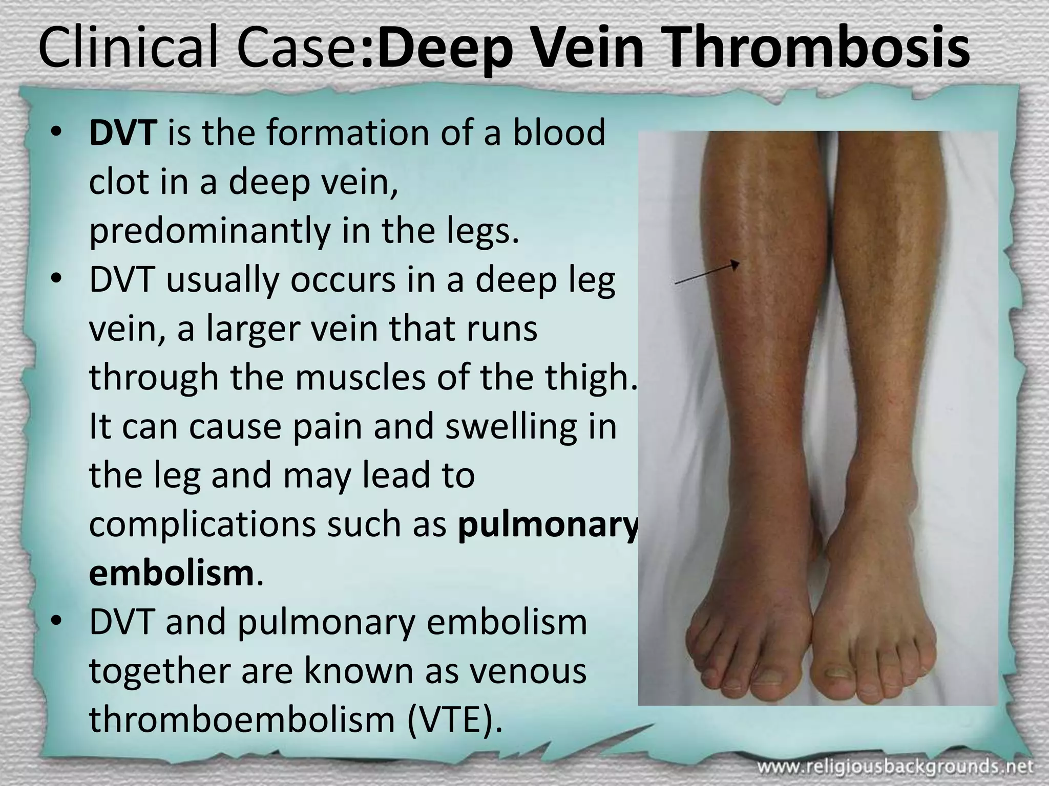 Clinical Case:Deep Vein Thrombosis
• DVT is the formation of a blood
clot in a deep vein,
predominantly in the legs.
• DVT usually occurs in a deep leg
vein, a larger vein that runs
through the muscles of the thigh.
It can cause pain and swelling in
the leg and may lead to
complications such as pulmonary
embolism.
• DVT and pulmonary embolism
together are known as venous
thromboembolism (VTE).

 