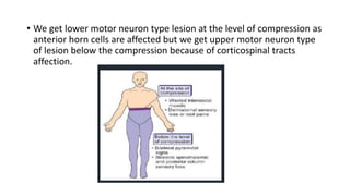 • We get lower motor neuron type lesion at the level of compression as
anterior horn cells are affected but we get upper motor neuron type
of lesion below the compression because of corticospinal tracts
affection.
 