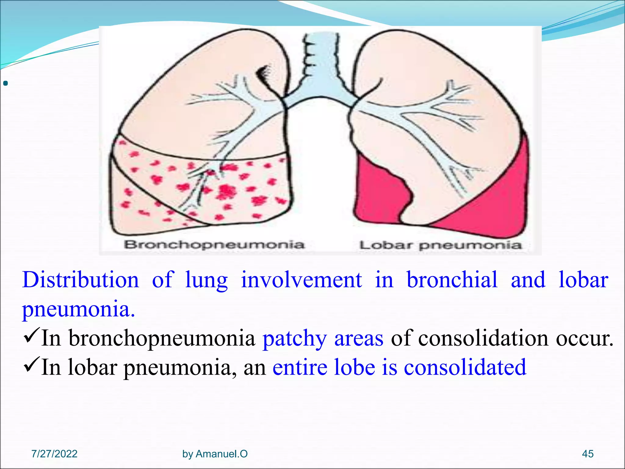 by Amanuel.O 45
.
Distribution of lung involvement in bronchial and lobar
pneumonia.
In bronchopneumonia patchy areas of consolidation occur.
In lobar pneumonia, an entire lobe is consolidated
7/27/2022
 
