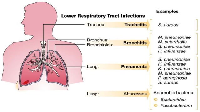 Lower Infection Rates Lower Respiratory Tract Infections.pptx