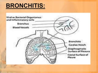 BRONCHITIS:
 