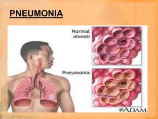 PNEUMONIA
 