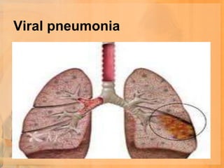 Viral pneumonia
 