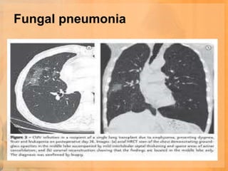 Fungal pneumonia
 