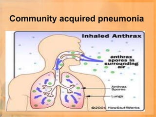 Community acquired pneumonia
 