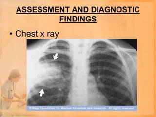 ASSESSMENT AND DIAGNOSTIC
         FINDINGS
• Chest x ray
 