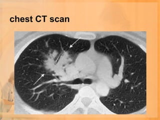 chest CT scan
 