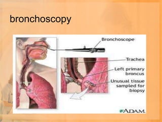 bronchoscopy
 