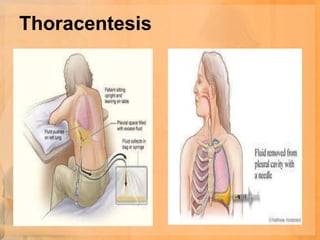 Thoracentesis
 
