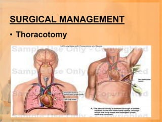 SURGICAL MANAGEMENT
• Thoracotomy
 