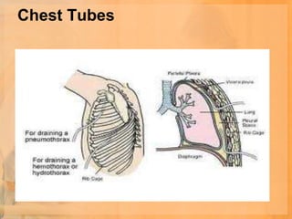 Chest Tubes
 