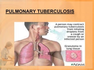 PULMONARY TUBERCULOSIS
 