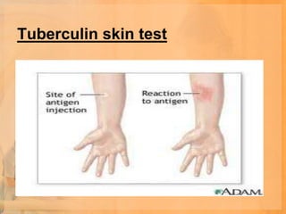 Tuberculin skin test
 