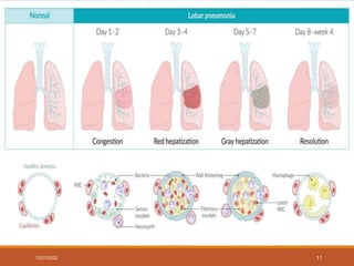 Stages of Pneumonia
Stage Time Macroscopy Microscopy
1. Congestion <24 hrs Red, heavy,
boggy
Vessels dilated,
alveolar exudate
with bacteria
2. Red
hepatization
2-3 days Red, airless Alveolar exudate
+ neutrophils,
RBCs, fibrin
3. Gray
hepatization
4-6 days Grey Fragmented
RBCs+pic as
stage 2.
4. Resolution > 6 days Normal Enzymatic
digestion of
exudates
12/21/2022 11
 