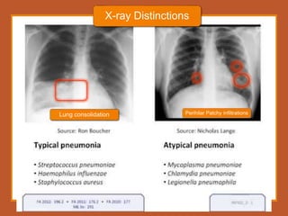 12/21/2022 12
X-ray Distinctions
Perihilar Patchy infiltrations
Lung consolidation
 