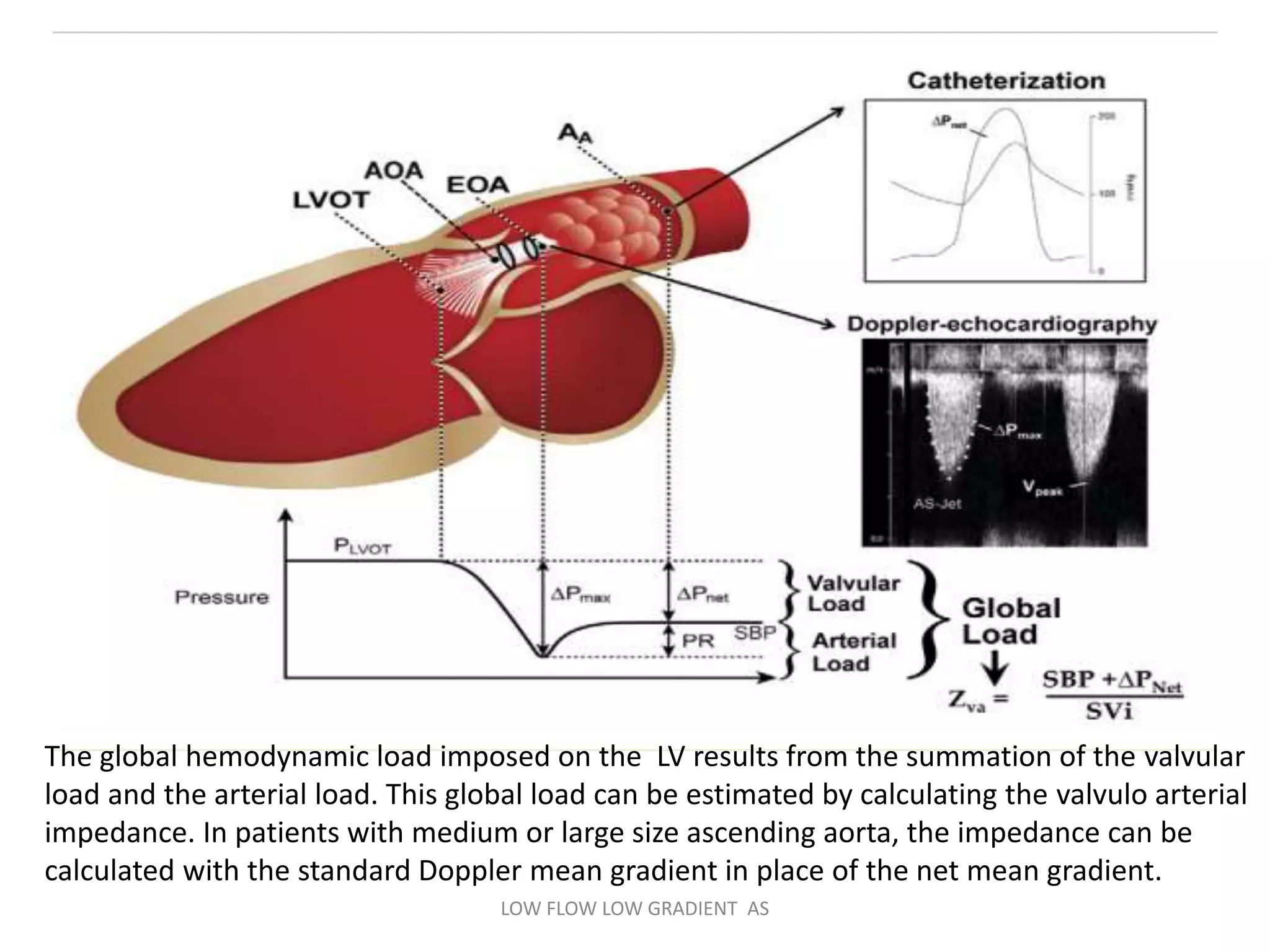 The global hemodynamic load imposed on the LV results from the summation of the valvular
load and the arterial load. This global load can be estimated by calculating the valvulo arterial
impedance. In patients with medium or large size ascending aorta, the impedance can be
calculated with the standard Doppler mean gradient in place of the net mean gradient.
LOW FLOW LOW GRADIENT AS
 