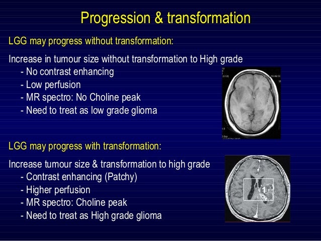Low Grade Glioma