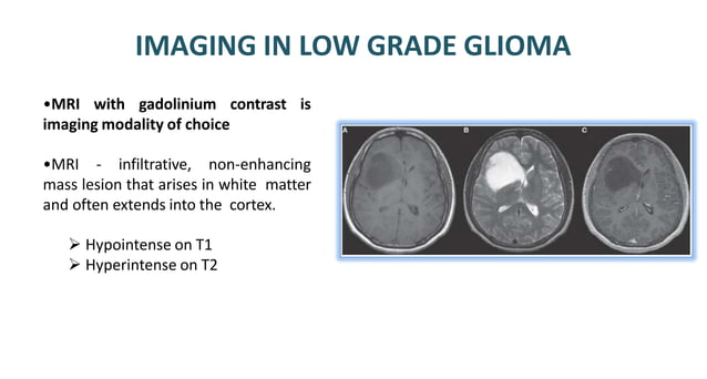LOW GRADE GLIOMA management in radiotherapy | PPT
