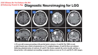 Low grade gliomas kiran | PPTX