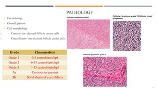 PATHOLOGY
• On histology,
• Growth pattern
• Cell morphology
a) Centrocytes- cleaved follicle center cells
b) Centroblasts- non-cleaved follicle center cells
Grade Characteristic
Grade 1 0-5 centroblasts/hpf
Grade 2 6-15 centroblasts/hpf
Grade 3 > 15 centroblasts/hpf
3a Centrocytes present
3b Solid sheets of centroblasts
 