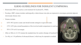 ILROG GUIDELINES FOR INDOLENT LYMPHOMA
• Historically IFRT was used as a sole treatment for localized FL, NMZL
• Nowdays, ISRT volume includes radiologically evident disease sites plus an expansion to encompass potential adjacent
microscopic disease sites
• Volume includes
a) GTV- PET positive nodes and should include enlarged or equivocal nodes
b) CTV- GTV plus extend bouandaries of the involved nodal compartment in axial and craniocaudal plane
c) PTV- CTV to 0.5 cm margin
• 24Gy to 30Gy in 12-15# remains the standard dose for curative therapy of localized FL
• 2 to 4Gy in 1-2# palliation of advanced disease ( which may be repeated as needed)
 