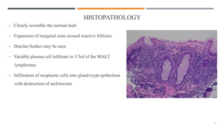 HISTOPATHOLOGY
• Closely resemble the normal malt
• Expansion of marginal zone around reactive follicles
• Dutcher bodies may be seen
• Variable plasma cell infiltrate in 1/3rd of the MALT
lymphomas
• Infiltration of neoplastic cells into gland/crypt epithelium
with destruction of architecture
 