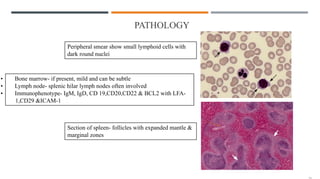 PATHOLOGY
Peripheral smear show small lymphoid cells with
dark round nuclei
Section of spleen- follicles with expanded mantle &
marginal zones
• Bone marrow- if present, mild and can be subtle
• Lymph node- splenic hilar lymph nodes often involved
• Immunophenotype- IgM, IgD, CD 19,CD20,CD22 & BCL2 with LFA-
1,CD29 &ICAM-1
 