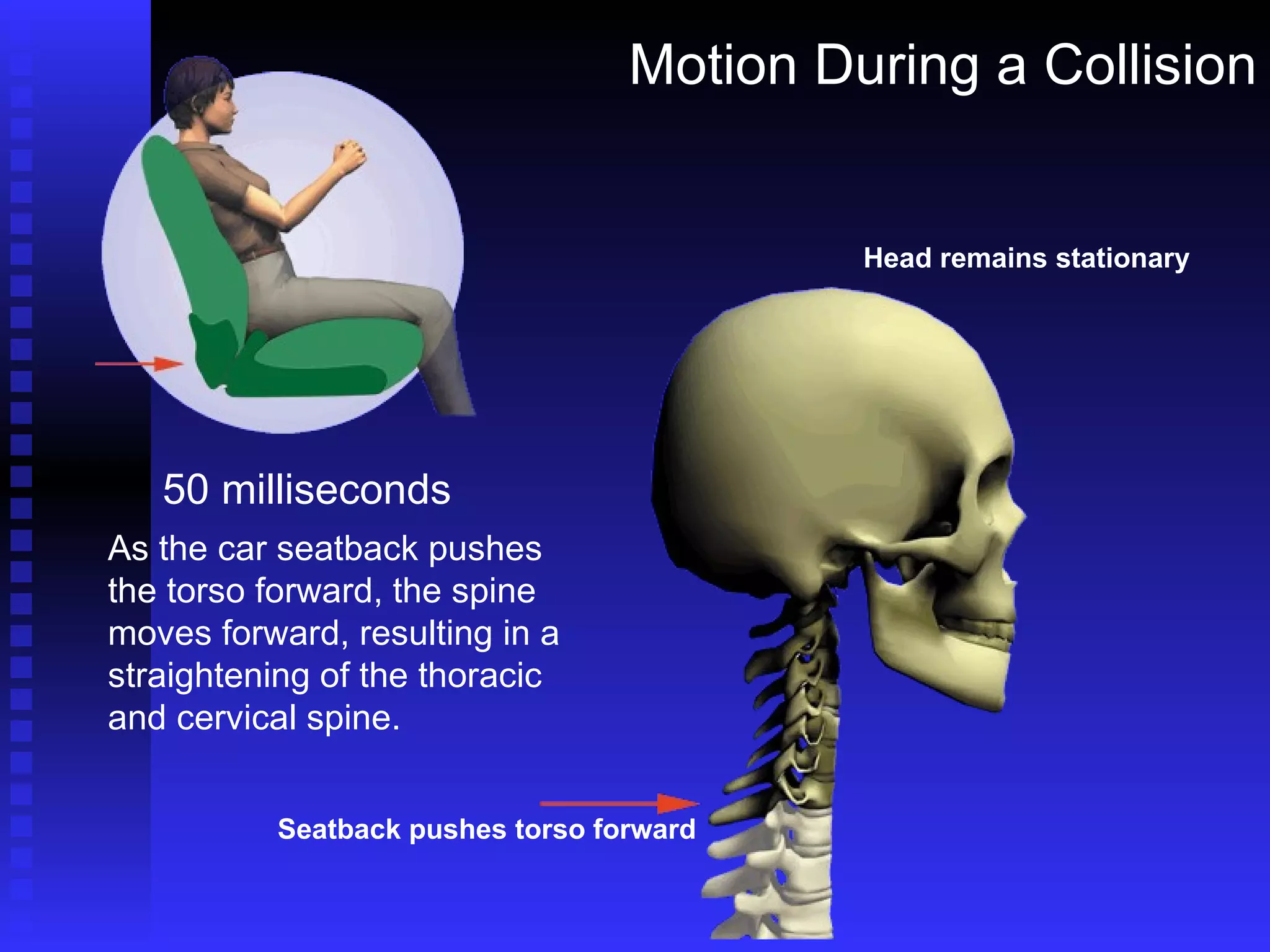 Motion During a Collision 50 milliseconds As the car seatback pushes the torso forward, the spine moves forward, resulting in a straightening of the thoracic and cervical spine. Head remains stationary Seatback pushes torso forward 
