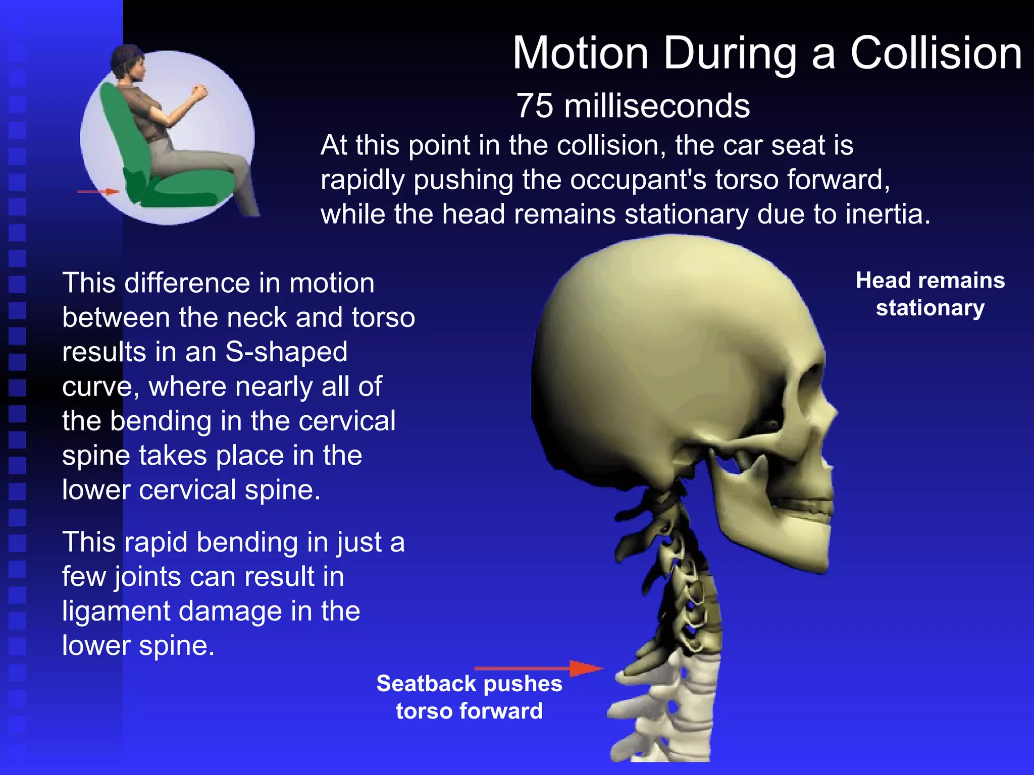 Motion During a Collision This difference in motion between the neck and torso results in an S-shaped curve, where nearly all of the bending in the cervical spine takes place in the lower cervical spine. This rapid bending in just a few joints can result in ligament damage in the lower spine. 75 milliseconds At this point in the collision, the car seat is rapidly pushing the occupant's torso forward, while the head remains stationary due to inertia. Head remains stationary Seatback pushes torso forward 