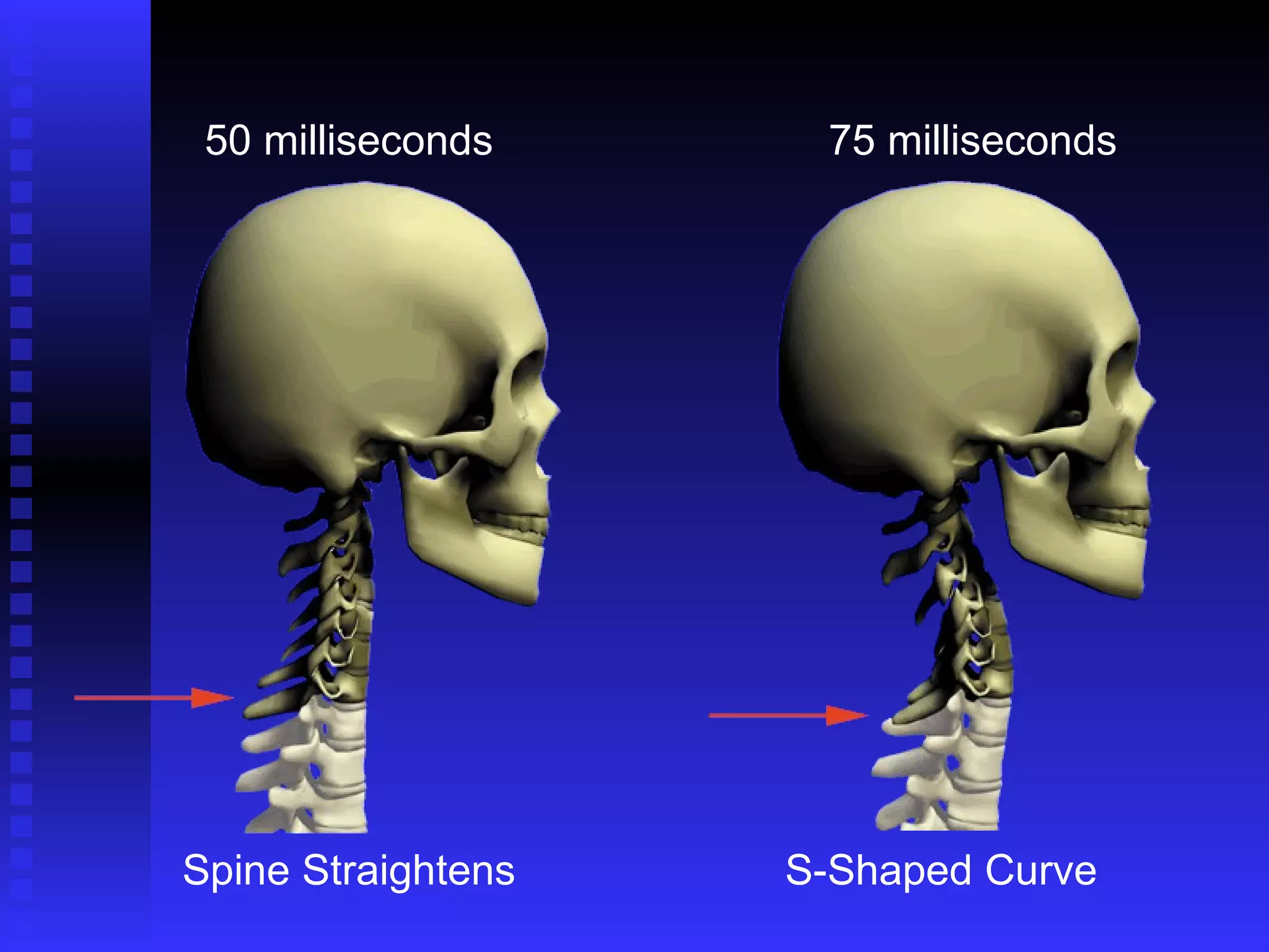75 milliseconds 50 milliseconds Spine Straightens S-Shaped Curve 