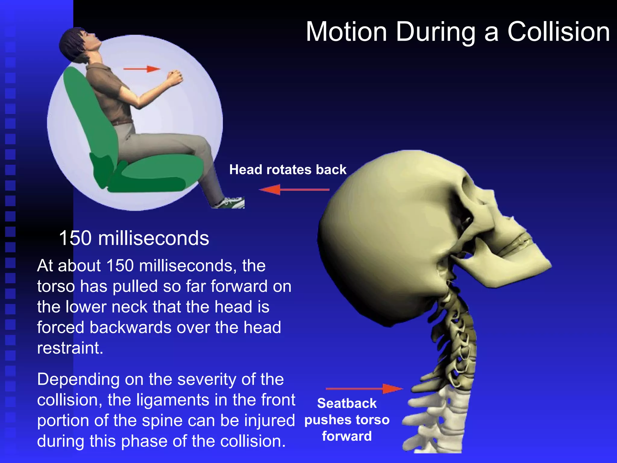 Motion During a Collision 150 milliseconds At about 150 milliseconds, the torso has pulled so far forward on the lower neck that the head is forced backwards over the head restraint. Depending on the severity of the collision, the ligaments in the front portion of the spine can be injured during this phase of the collision. Head rotates back Seatback pushes torso forward 