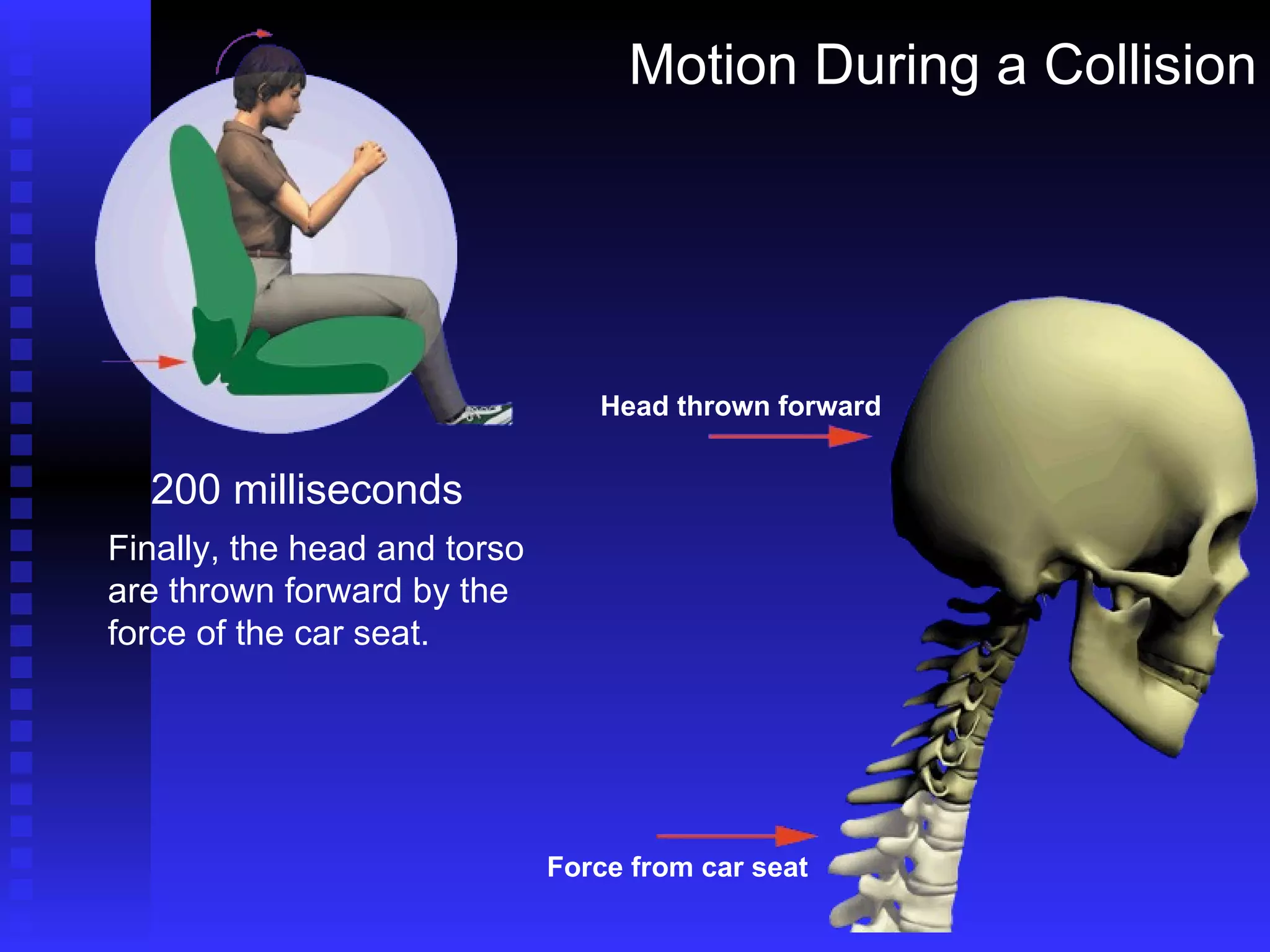 Motion During a Collision 200 milliseconds Finally, the head and torso are thrown forward by the force of the car seat. Head thrown forward Force from car seat 