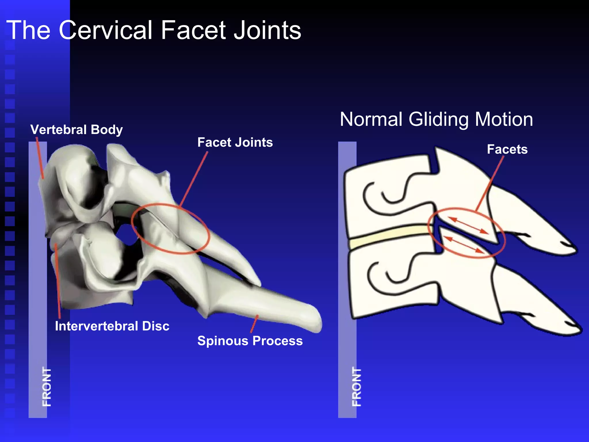 The Cervical Facet Joints Vertebral Body Facet Joints Intervertebral Disc Spinous Process Facets Normal Gliding Motion 